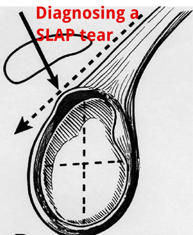 An Update on Diagnosing SLAP tears
