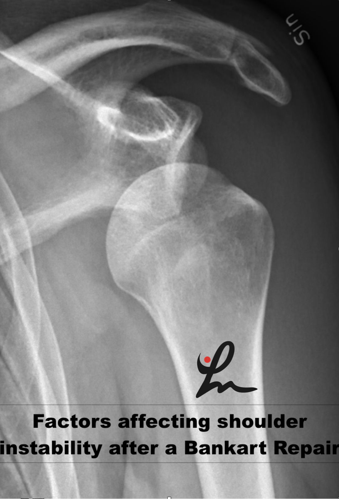 Risk Factors for Recurrent Instability After a Bankart Repair Surgery