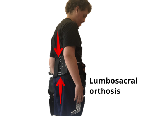Brace used to help restrict motion during a low back stress fracture