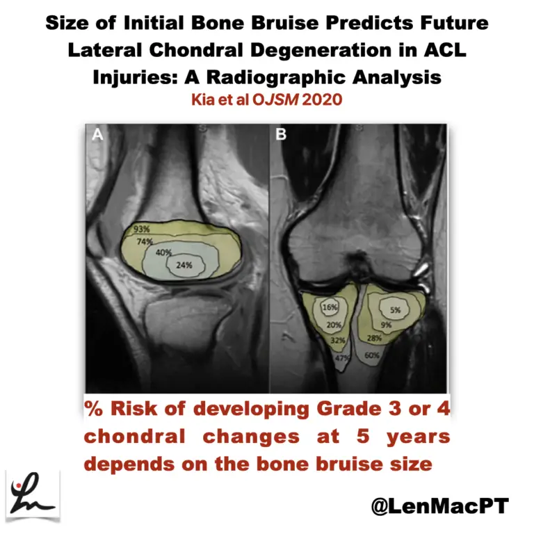 ACL tears and bone bruises