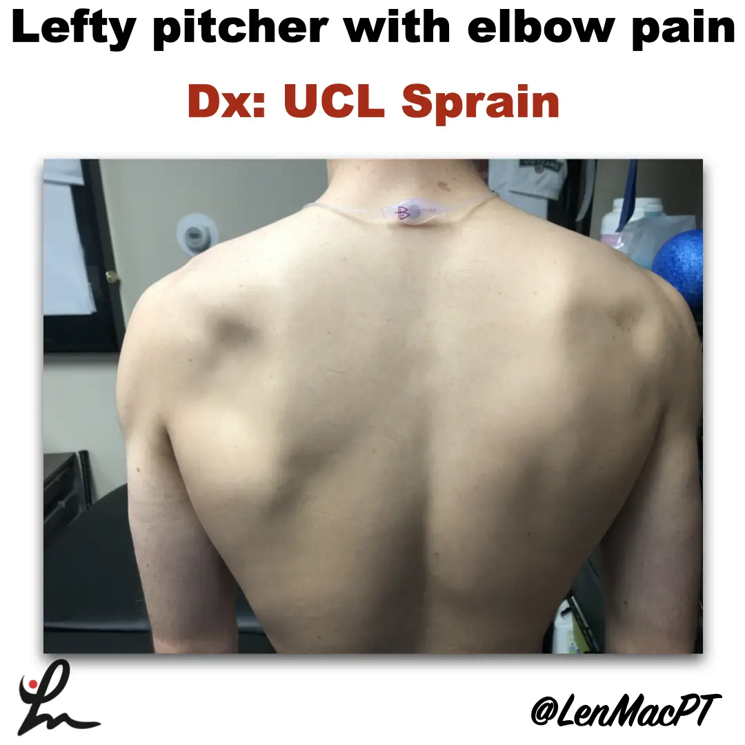 Infraspinatus atrophy in a baseball pitcher with a UCL sprain