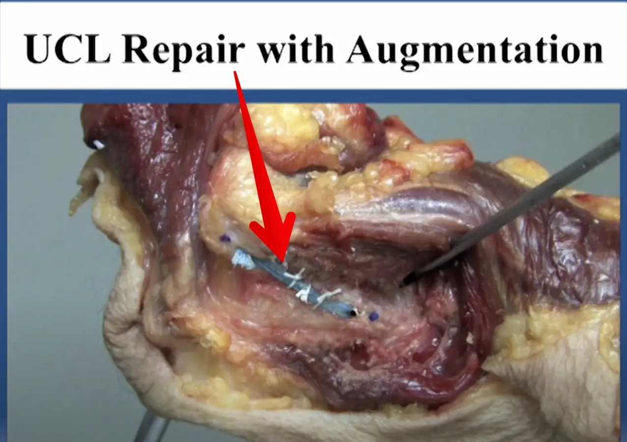 Diagnosed with an elbow UCL Tear- Reconstruction or Internal Brace surgery?