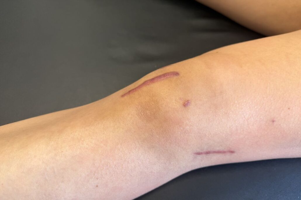 Lateral extra-articular tenodesis incision and ACL graft incision on the knee