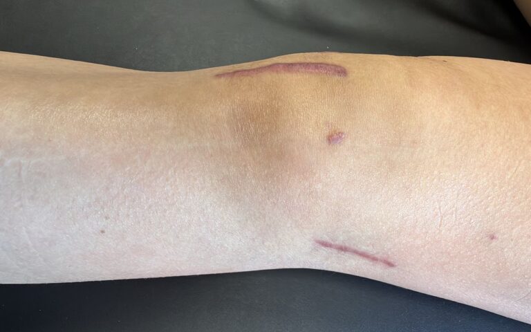 ACL Reconstruction With an LET: What Changes in Rehab?
