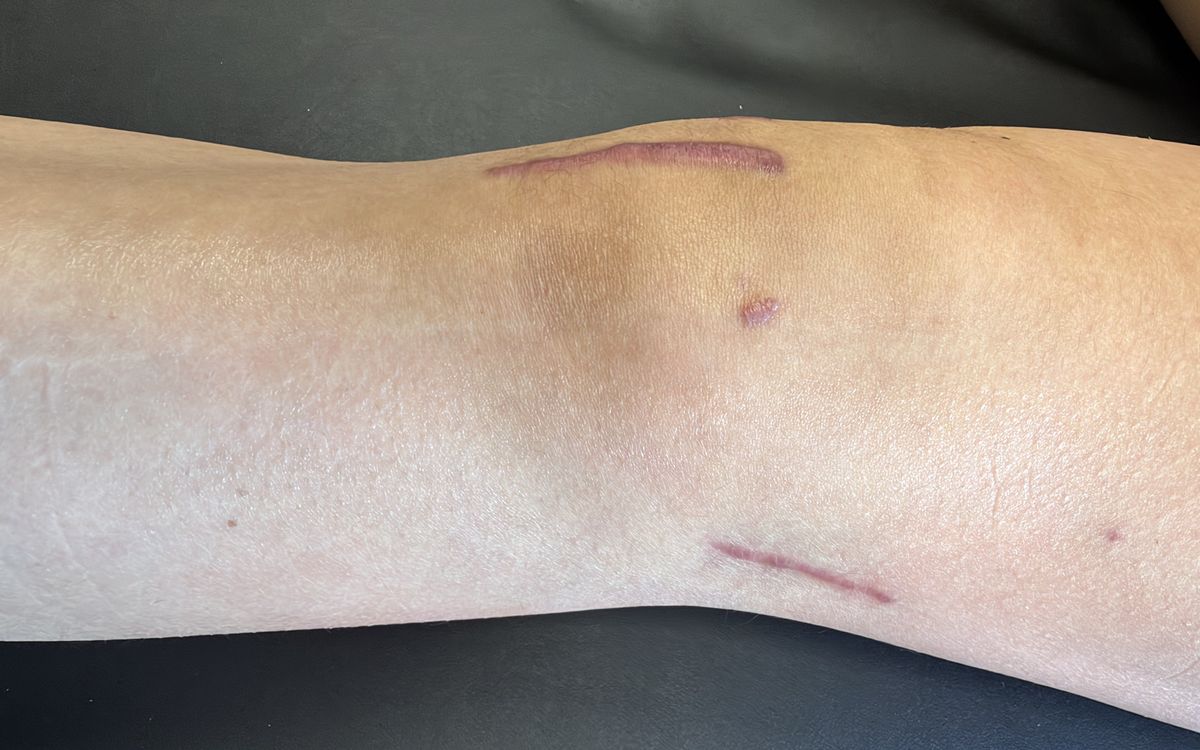 Lateral extra-articular tenodesis (LET) incision after ACL reconstruction